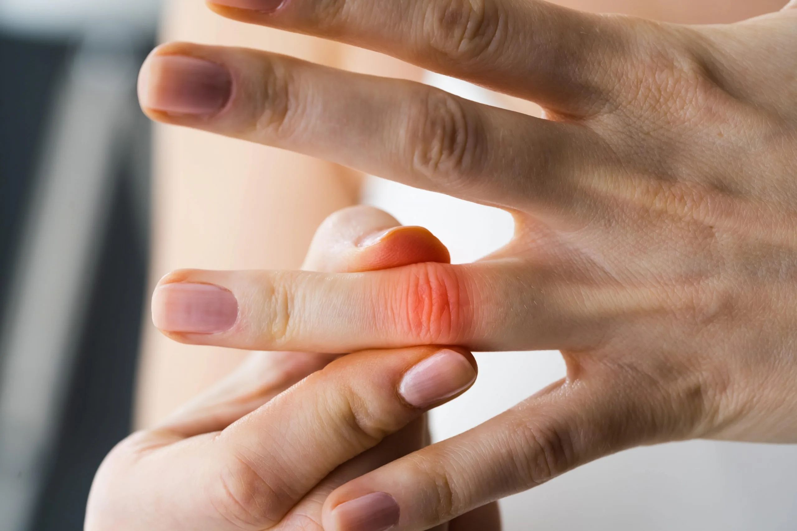 How to Get Rid of Swollen Fingers