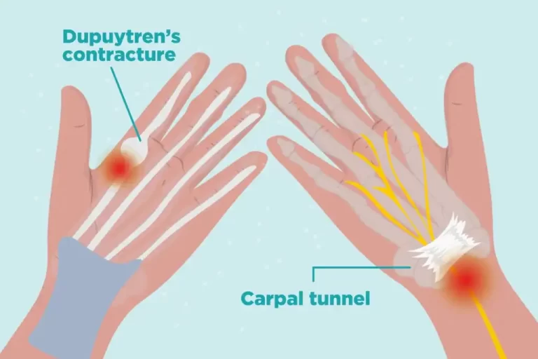 Hand Joint Pain