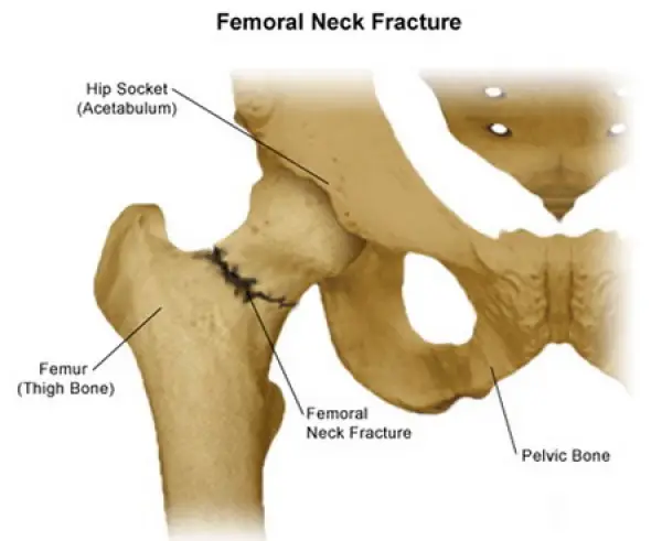 Hip Fracture Femoral Fracture
