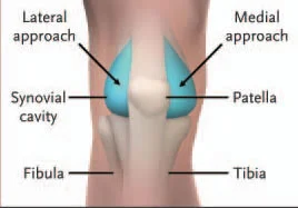knee-arthrocentesis