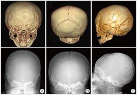 Skull Fractures