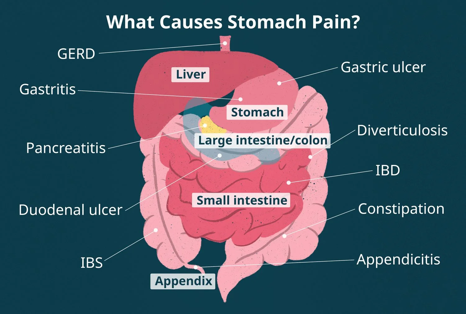 Upper Abdominal Pain Causes Symptoms Diagnosis Treatmen