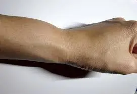 Swollen Wrist