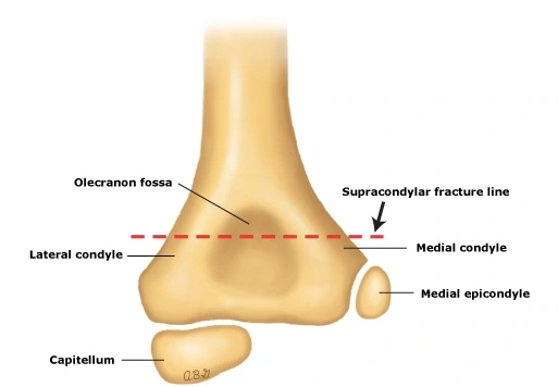 Anatomy of Supracondylar Humerus Fracture