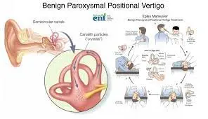 Benign Paroxysmal Positional Vertigo (BPPV) Medical Treatment