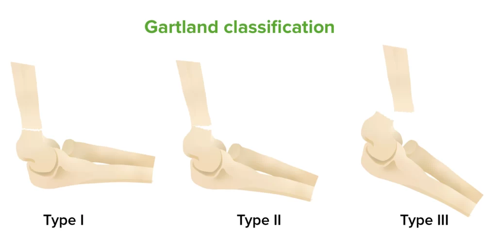 Gartland Classification of Supracondylar Fracture