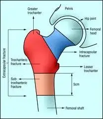 Hip fracture neck