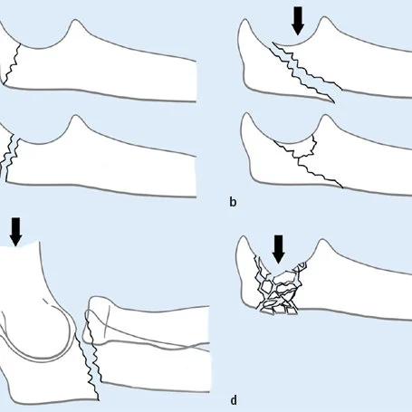 Mayo Classification For Olecranon Fracture