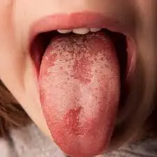 Sore-tongue