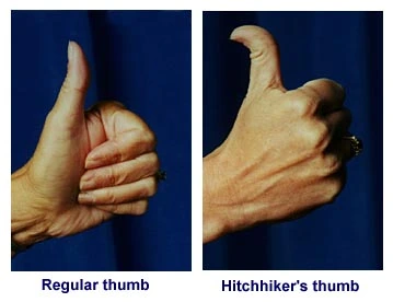 HITCHHIKER'S THUMB DEFORMITY