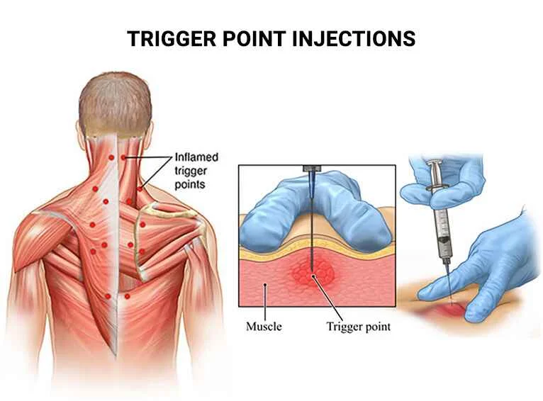Trigger-Point-Injections