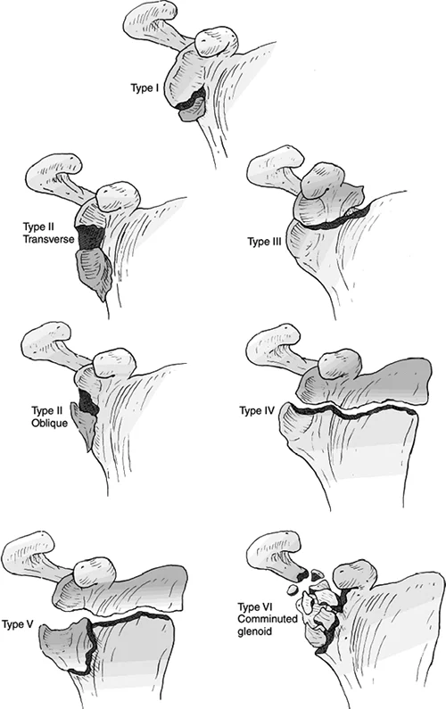Types of scapular fracture
