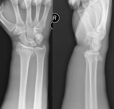 X-Rays of Smith Fracture