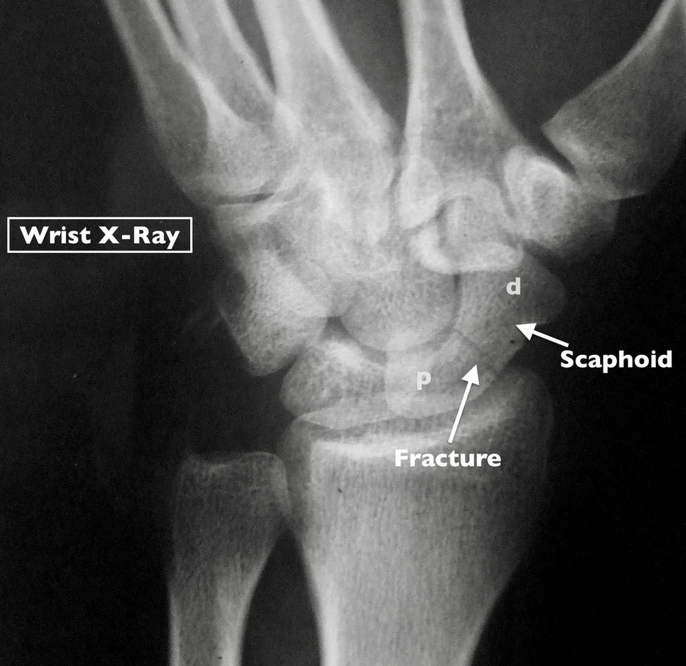 X-ray of scaphoid fracture