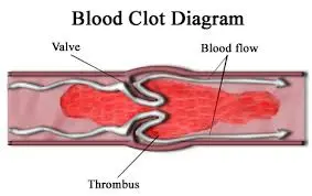 blood-clot