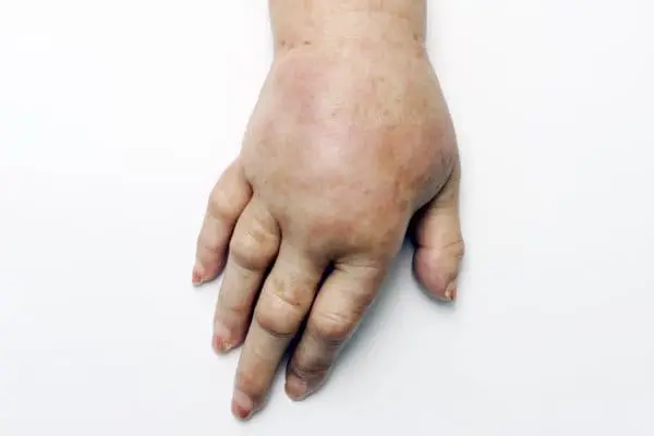 Hand Pain with Swelling