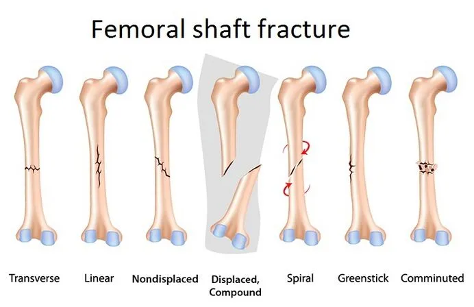 Femur shaft fracture