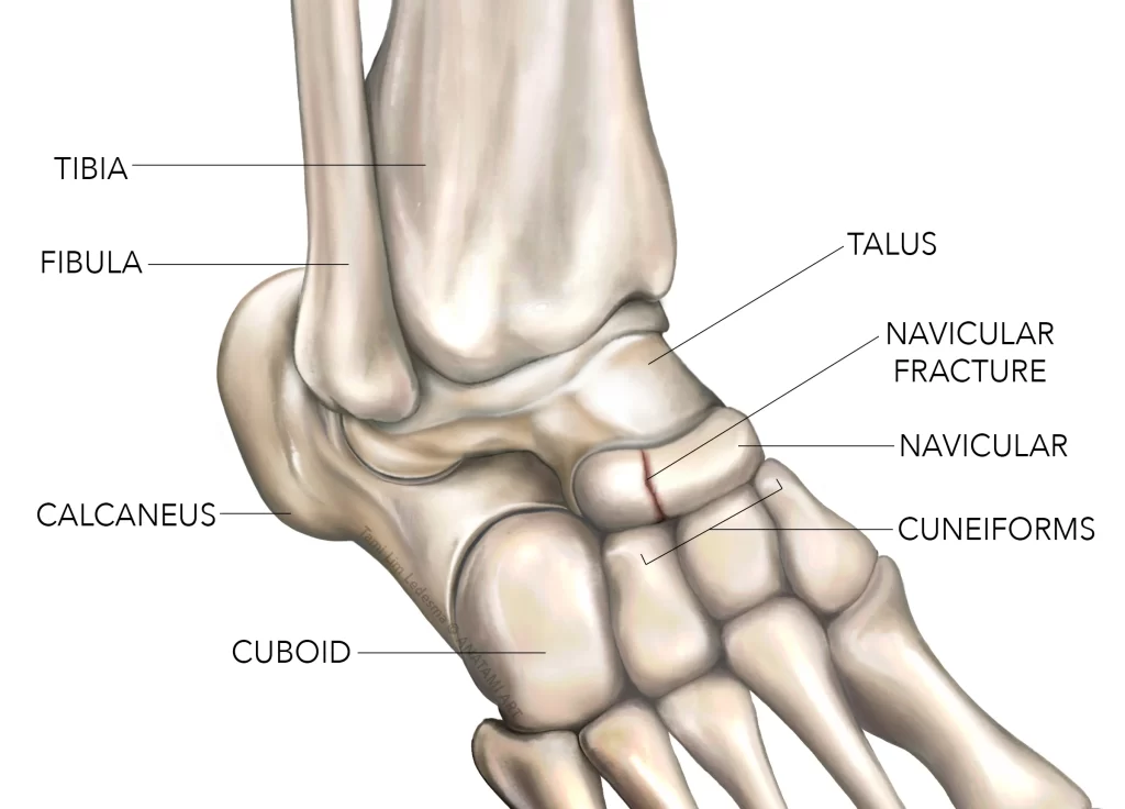 Navicular Fracture Symptoms Causes And Treatment