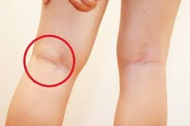 puffiness behind knee