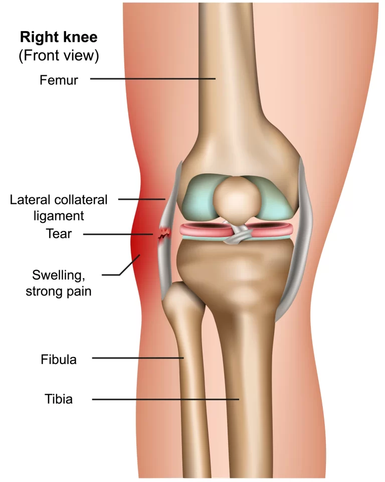 Lateral Collateral Ligament