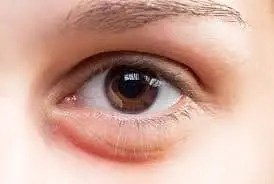 Under Eye Swelling