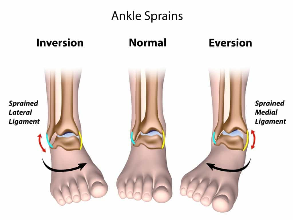 Ankle Inversion Sprain