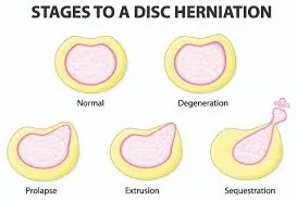 Stages of degenerative changes of Disc